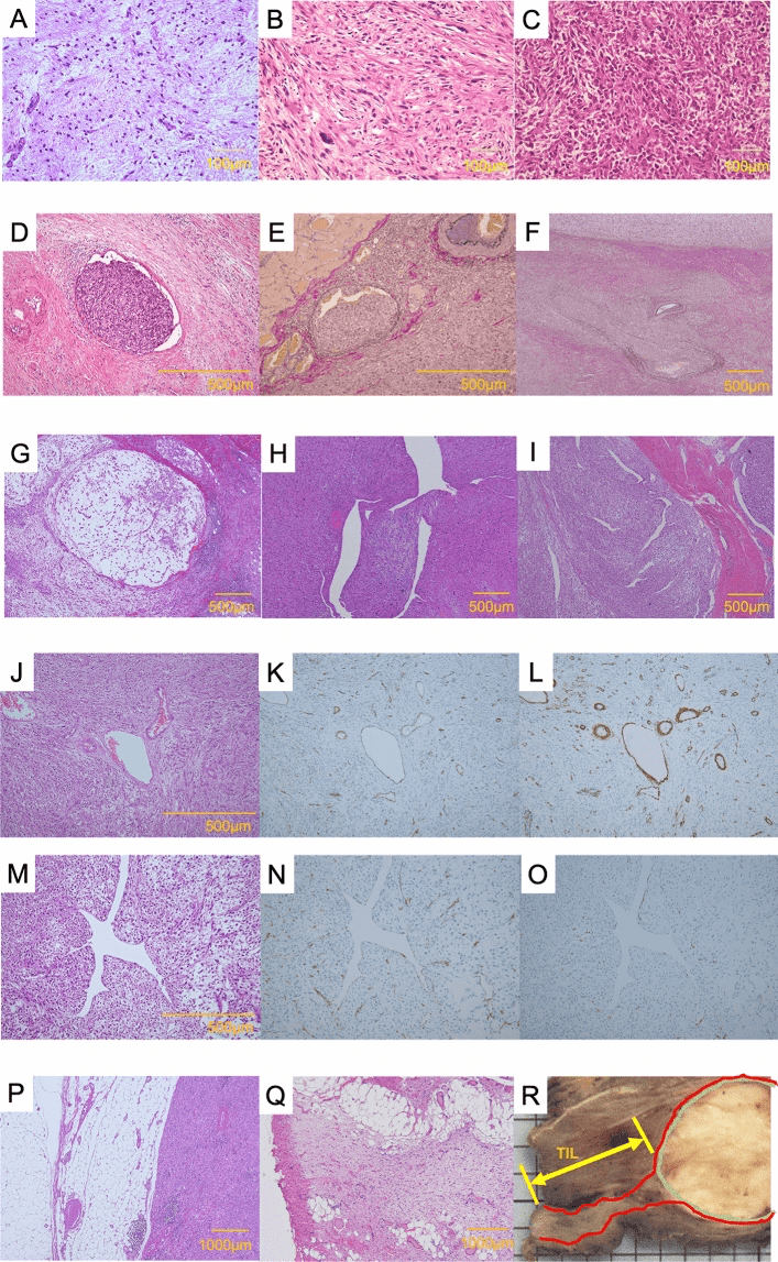 Histology of myxofibrosarcoma showing low, medium and high cellularity with a panel of vascular invasion