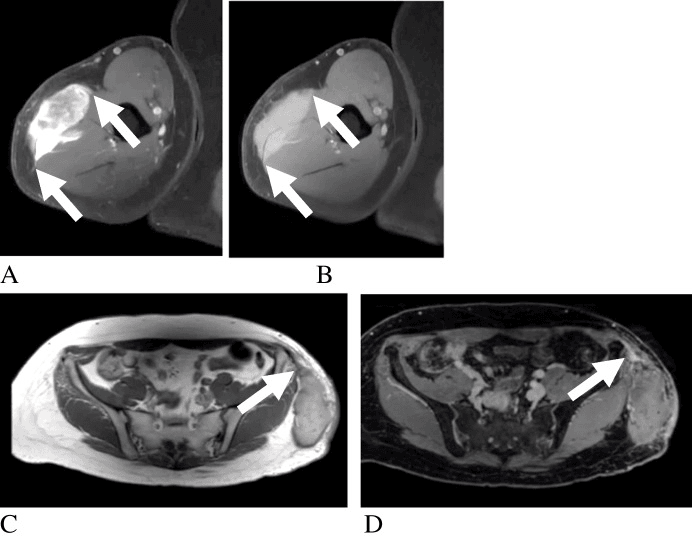 Axial MRI of myxofibrosarcoma in two patients showing heterogeneous masses with enhancing fascial tails