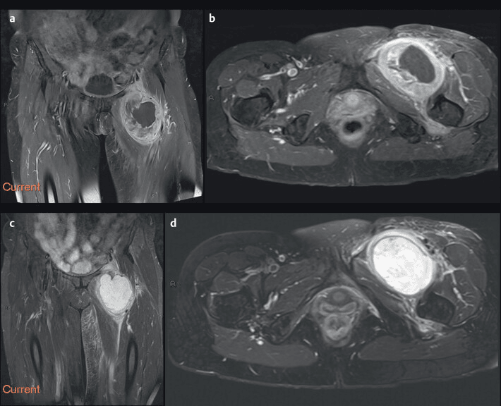 Post-contrast T1-weighted MRI of a myxofibrosarcoma showing circumferential enhancement of nodular soft-tissue components with a non-enhancing myxoid centre