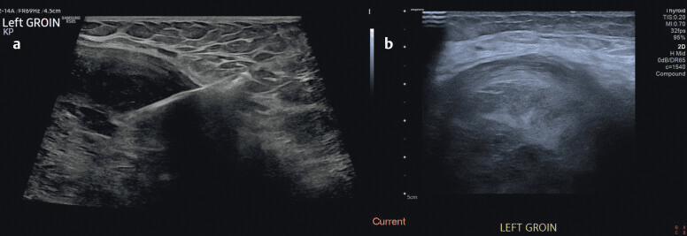 Ultrasound-guided core needle biopsy of a soft-tissue mass