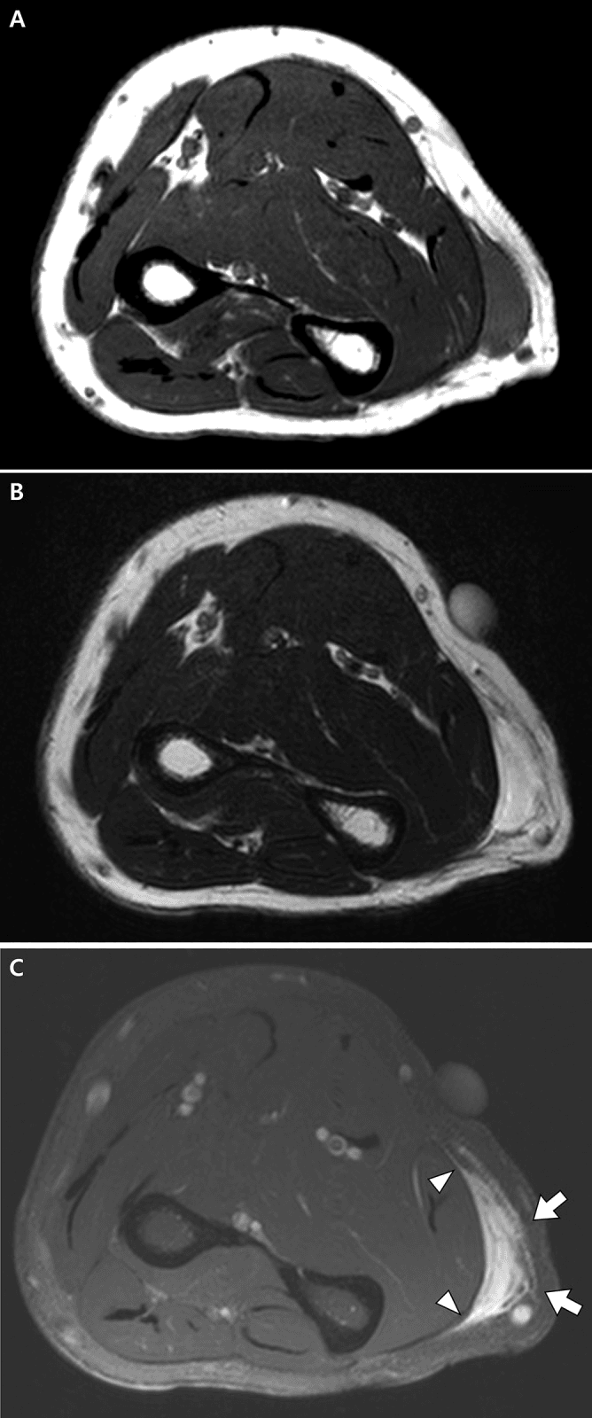 MRI of a subcutaneous forearm myxofibrosarcoma before unplanned excision showing peritumoural infiltrative enhancement