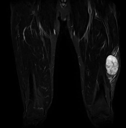 Coronal STIR MRI of the thighs showing a bright (T2/STIR-hyperintense) soft-tissue mass of myxofibrosarcoma