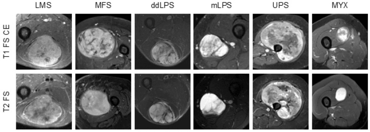 Grid of contrast-enhanced and T2-weighted MRI appearances of six soft-tissue sarcoma subtypes including myxofibrosarcoma