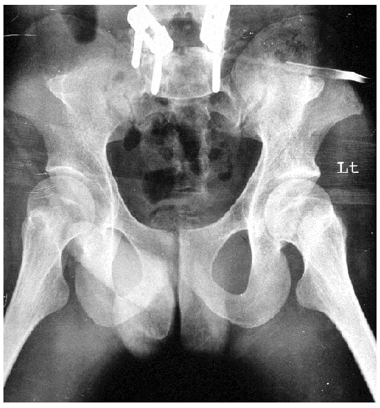 AP pelvis radiograph showing bilateral posterior iliac horns in nail-patella syndrome