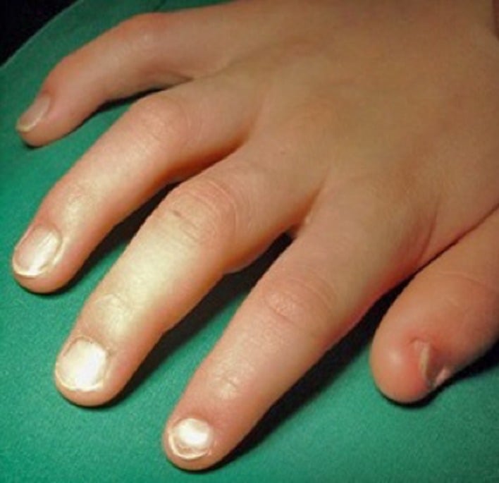 Dorsal hand photograph showing thumb-predominant hypoplastic fingernails