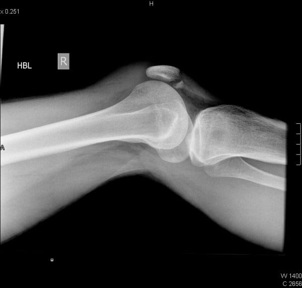 Lateral knee radiograph showing an inferior-pole fracture of a hypoplastic patella