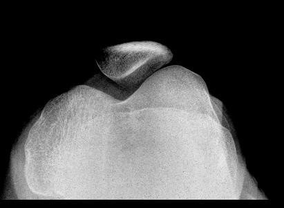 Skyline radiograph showing the small patella associated with nail-patella syndrome