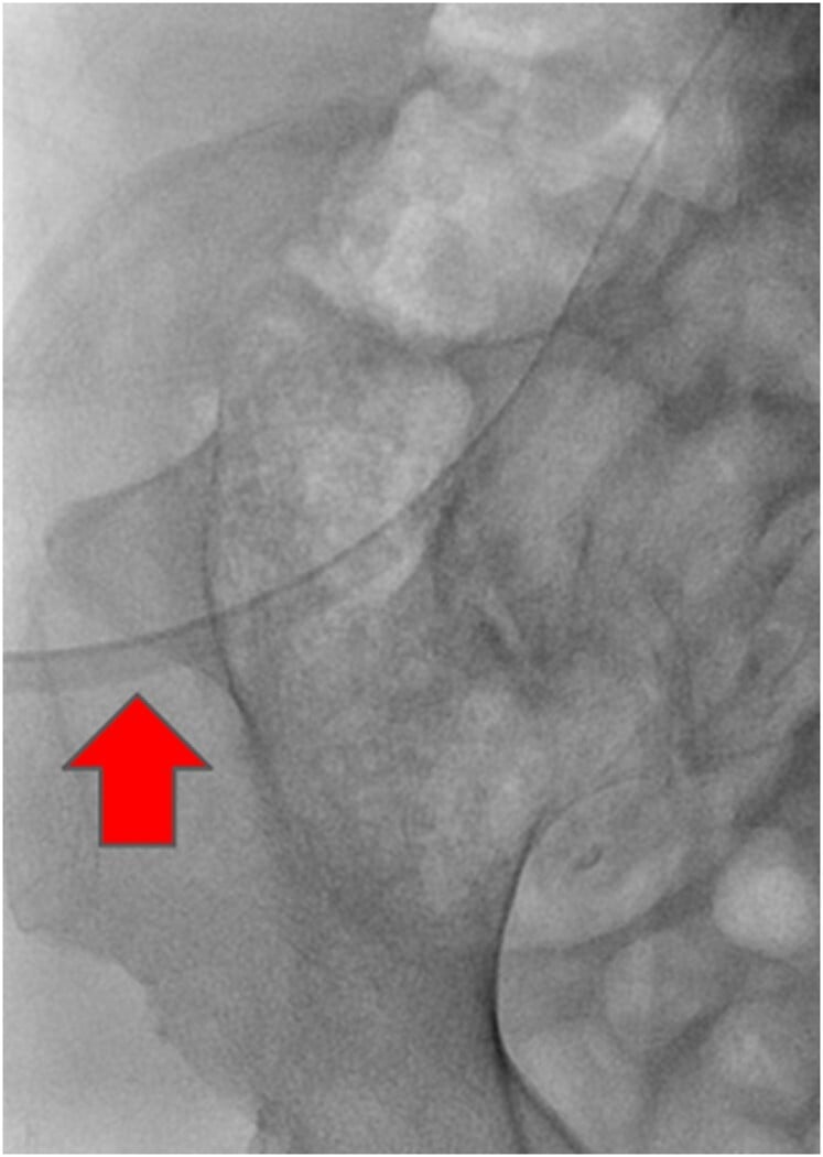 Close-up AP pelvic radiograph showing a triangular posterior iliac horn