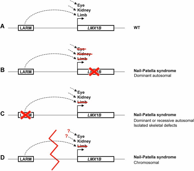 Diagram comparing coding, regulatory and structural LMX1B disease mechanisms