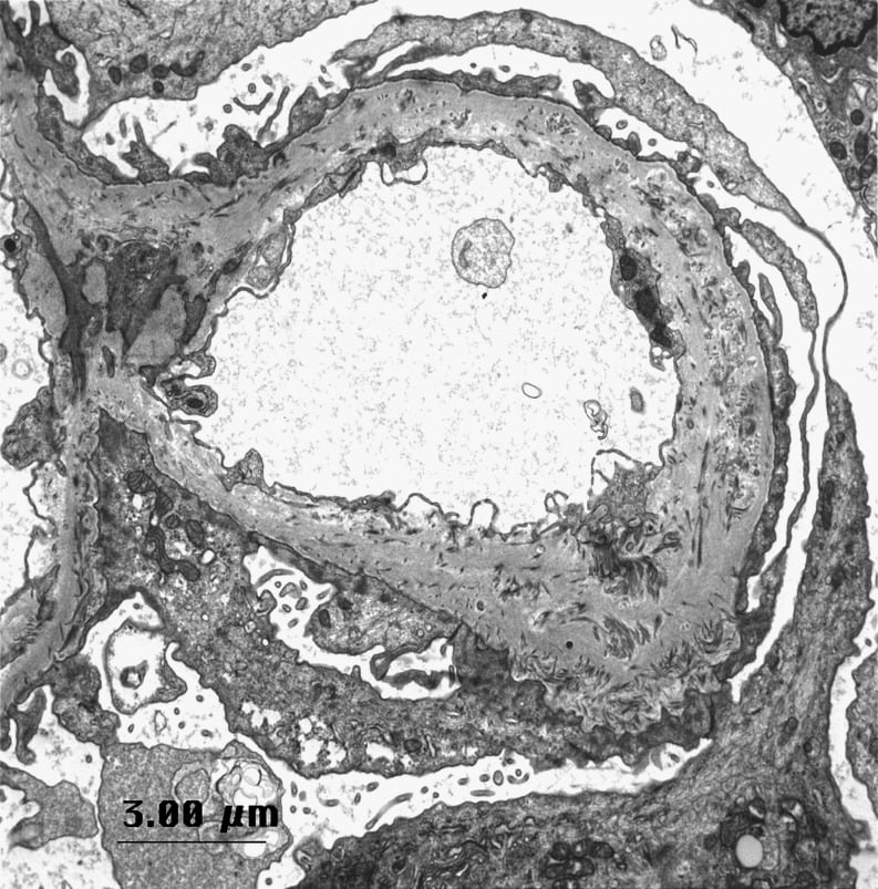 Electron micrograph showing irregular glomerular basement membrane thickening and collagen fibrils