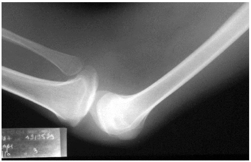 Lateral adult knee radiograph showing complete patellar aplasia in nail-patella syndrome