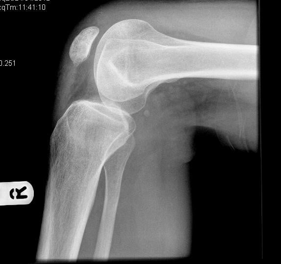 Six-month lateral radiograph after fixation of a hypoplastic patellar fracture