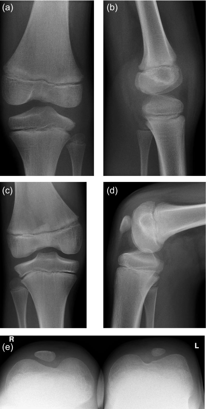 Serial knee radiographs after trochlear septum resection showing later patellar ossification