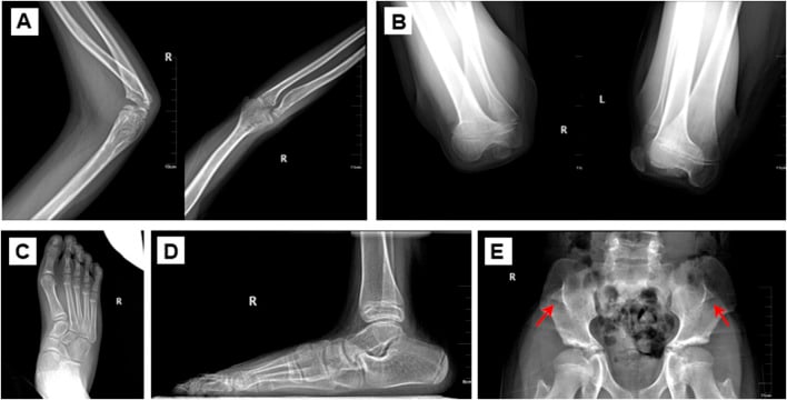 Composite radiographs showing radial-head dislocation, patellar dysplasia, pes planus and iliac horns