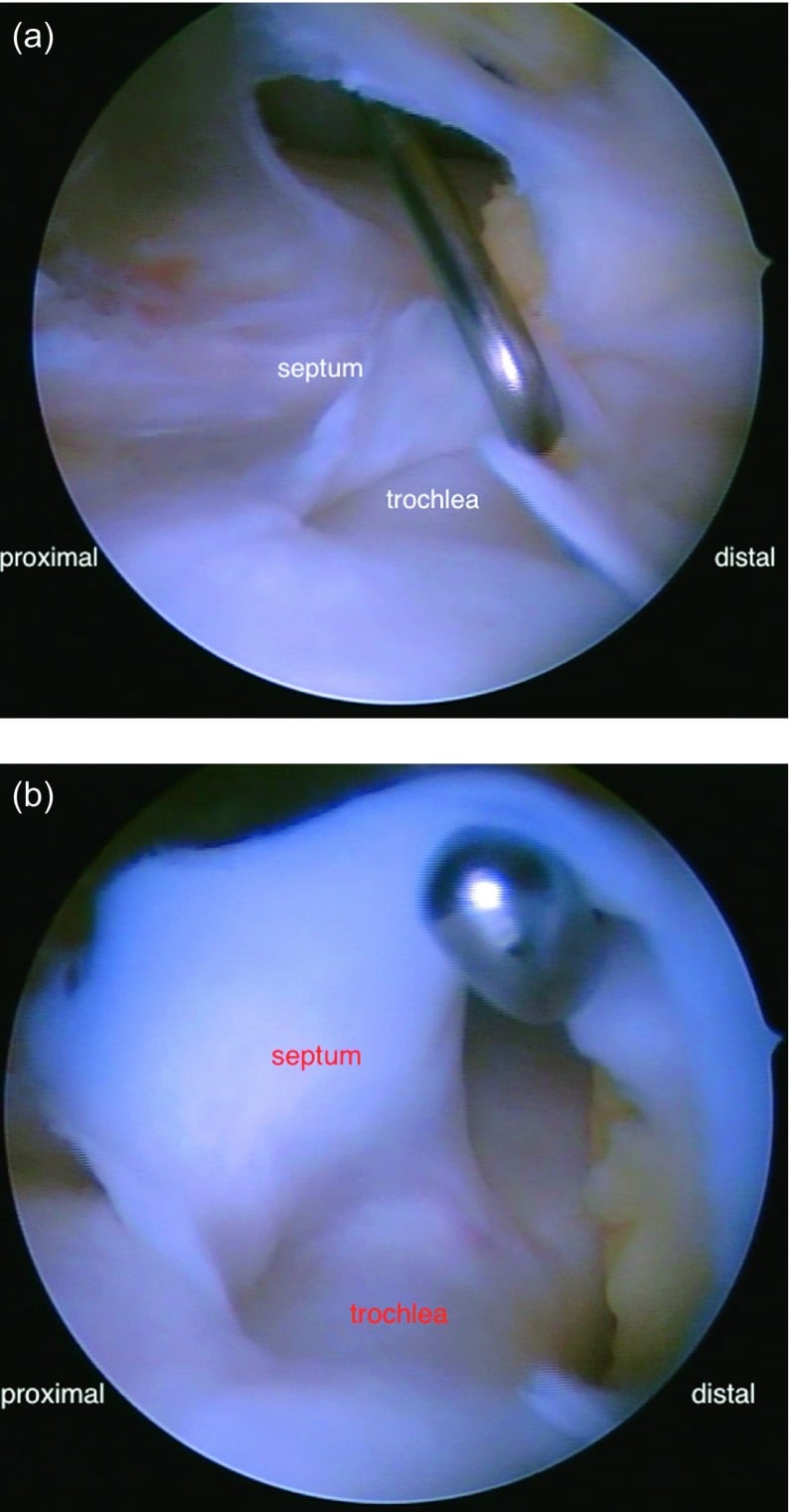Arthroscopic views of a sagittal trochlear septum during perforation and resection