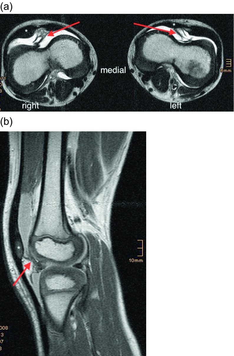 Axial and sagittal knee MRI showing a sagittal trochlear septum and laterally positioned patella
