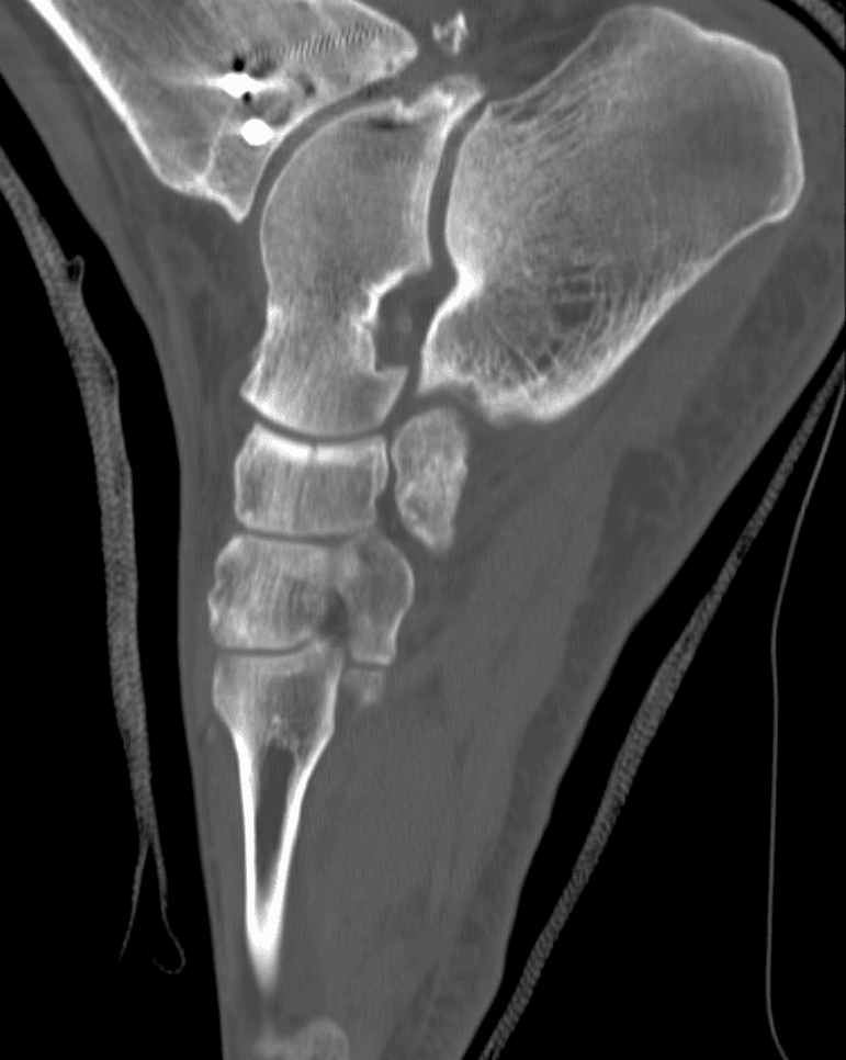 Sagittal CT of the foot showing a fracture of the tarsal navicular.