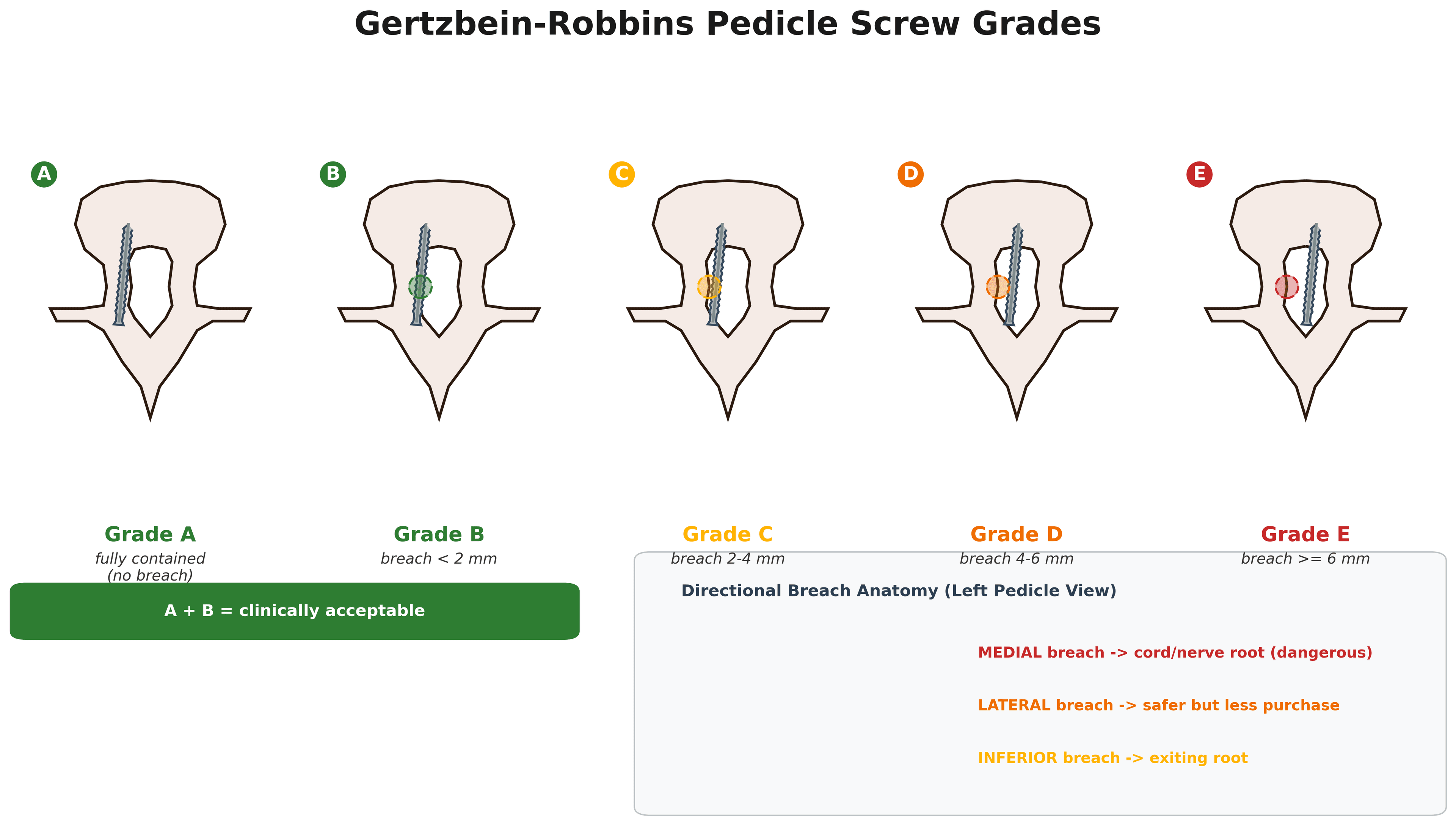 Axial vertebra diagram of the Gertzbein-Robbins pedicle screw grades A to E by cortical breach, with A and B marked clinically acceptable and a key for medial, lateral and inferior breach direction