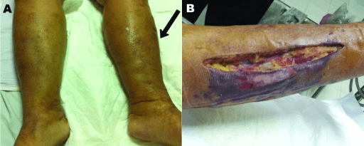 Clinical presentation and surgical debridement of necrotizing fasciitis