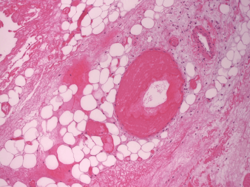 Histopathology of necrotizing fasciitis showing areactive necrosis