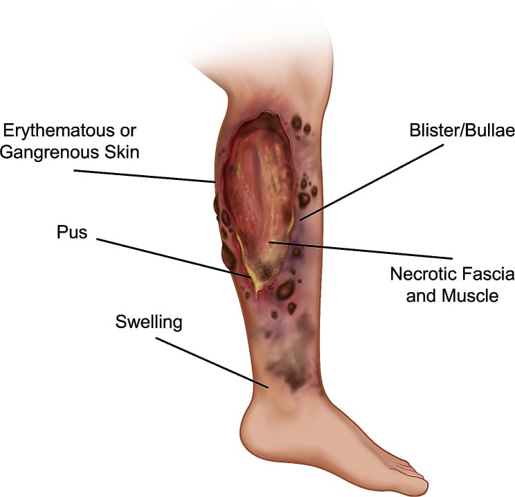 Medical illustration diagram of leg necrotizing fasciitis features