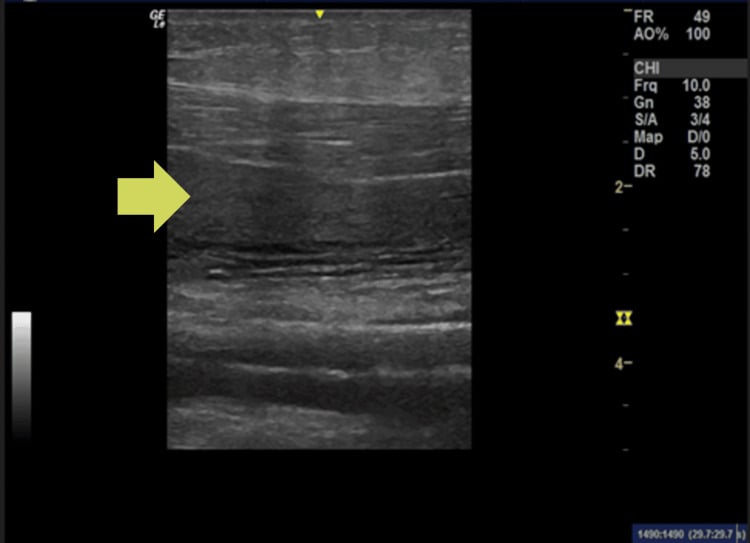 POCUS ultrasound of thigh demonstrating fascial fluid accumulation