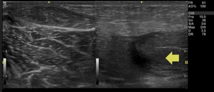 POCUS ultrasound demonstrating fascial thickening and subcutaneous air shadowing