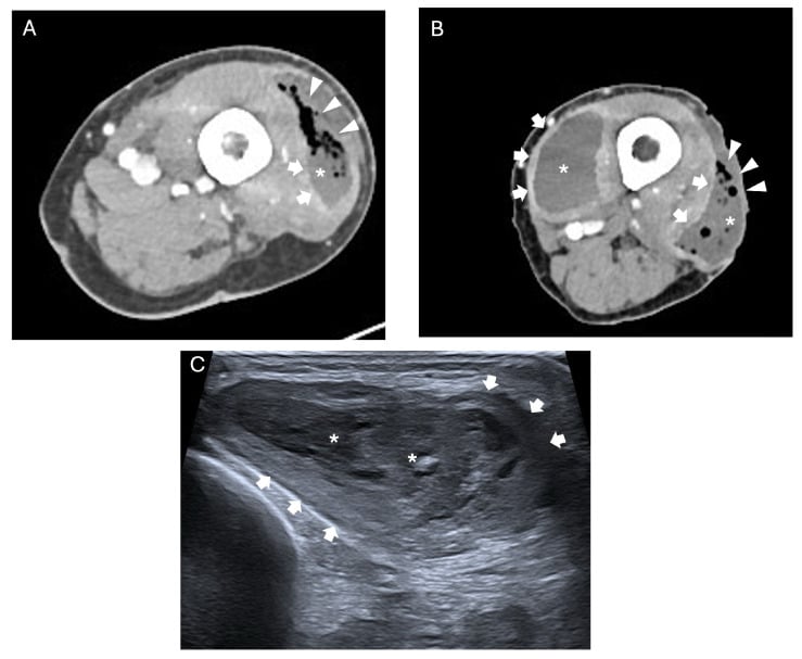 Axial CT and ultrasound of lower extremity necrotizing fasciitis