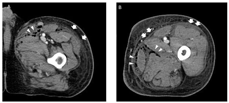 Axial CT scan showing fascial thickening and internal gas tracking