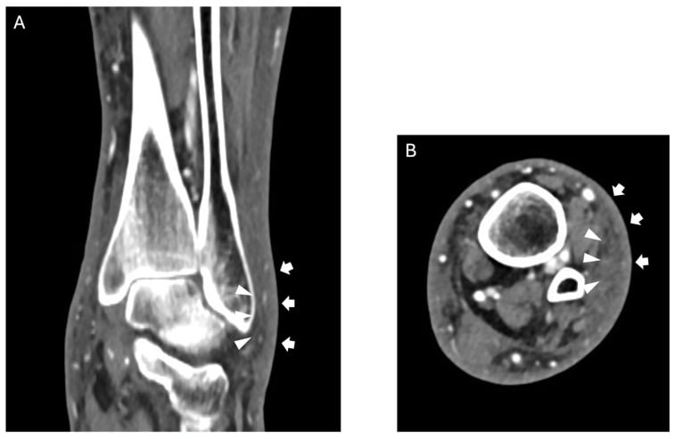 Coronal and axial CT scans demonstrating soft tissue emphysema