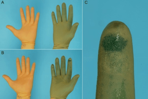 Double gloving with standard and coloured indicator gloves, with a needle perforation showing as a coloured spot on the index finger