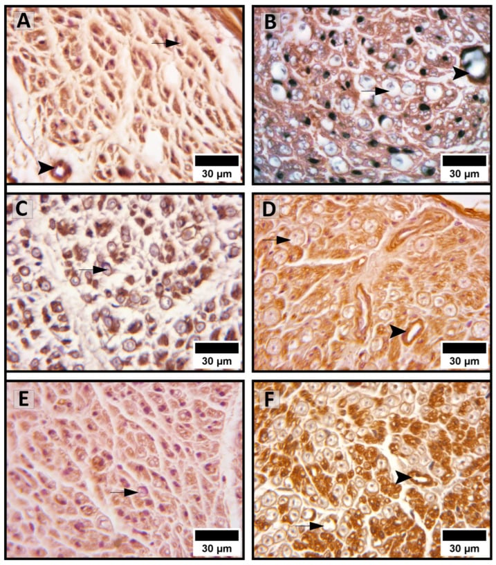 Sural nerve immunohistochemistry showing collagen and laminin in the endoneurium