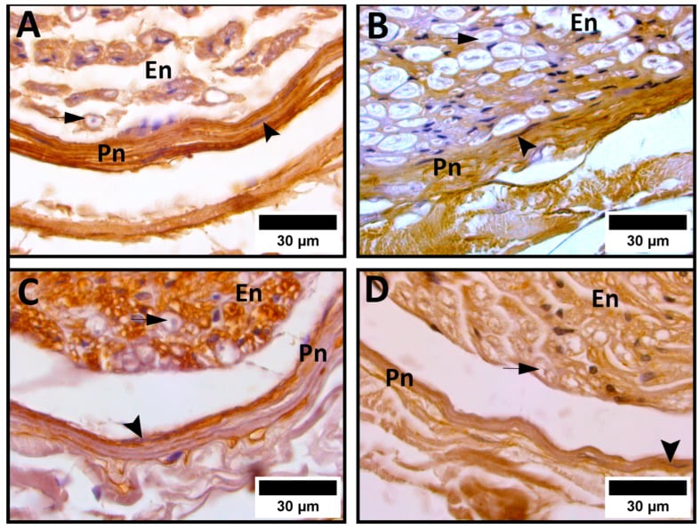 Sural nerve immunohistochemistry showing collagen and laminin in the perineurium