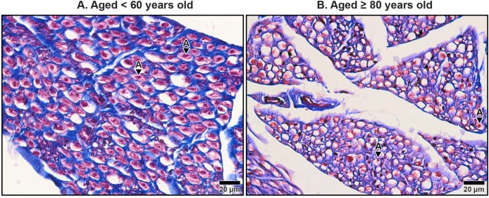 Histology of human median nerve showing endoneurium and myelinated axons