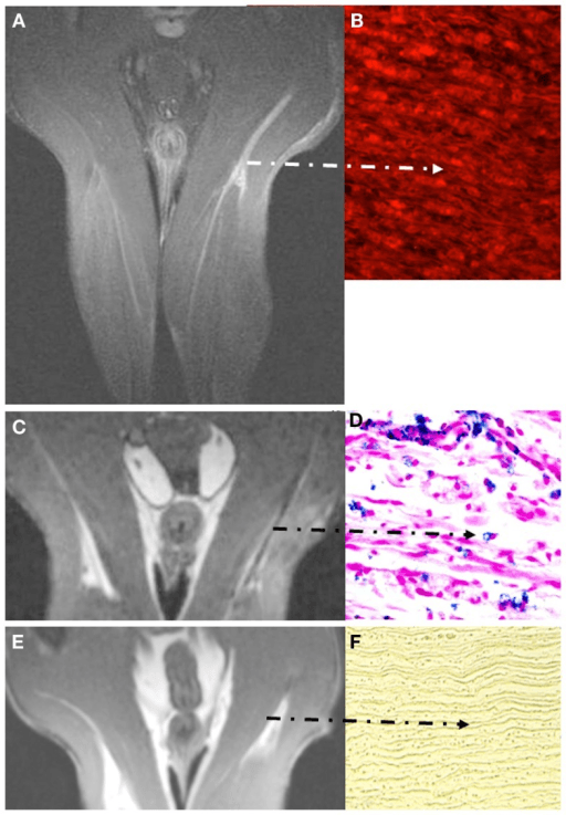 Six-panel experimental nerve-crush composite: greyscale coronal MR images of a rat pelvis and both thighs in the left column (A, C, E), with correlative micrographs in the right column - red immunofluorescence (B), pink and blue cellular histology (D), and a longitudinal yellow semithin nerve section (F); dashed arrows mark the injured sciatic nerve.