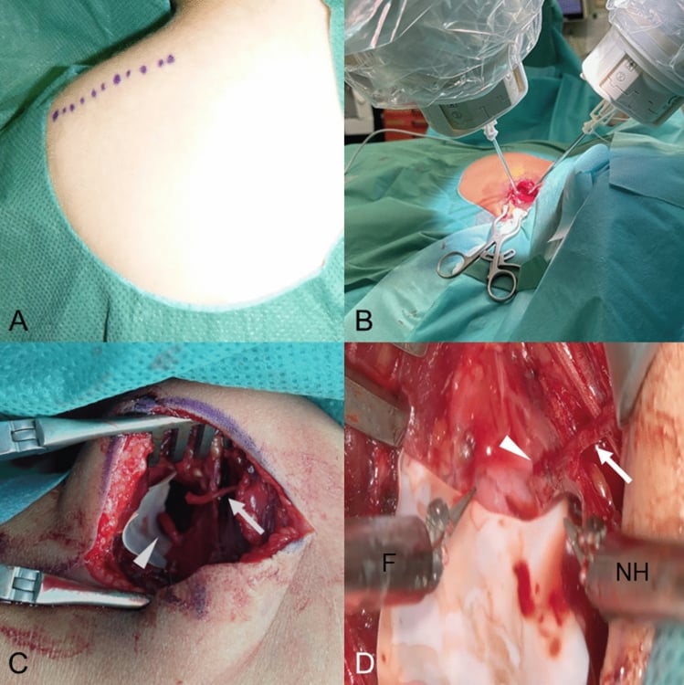 Dorsal approach and microsurgical spinal accessory to suprascapular nerve transfer