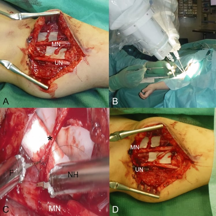 Medial upper-arm exposure and microsurgical double fascicle nerve transfer from median and ulnar donors