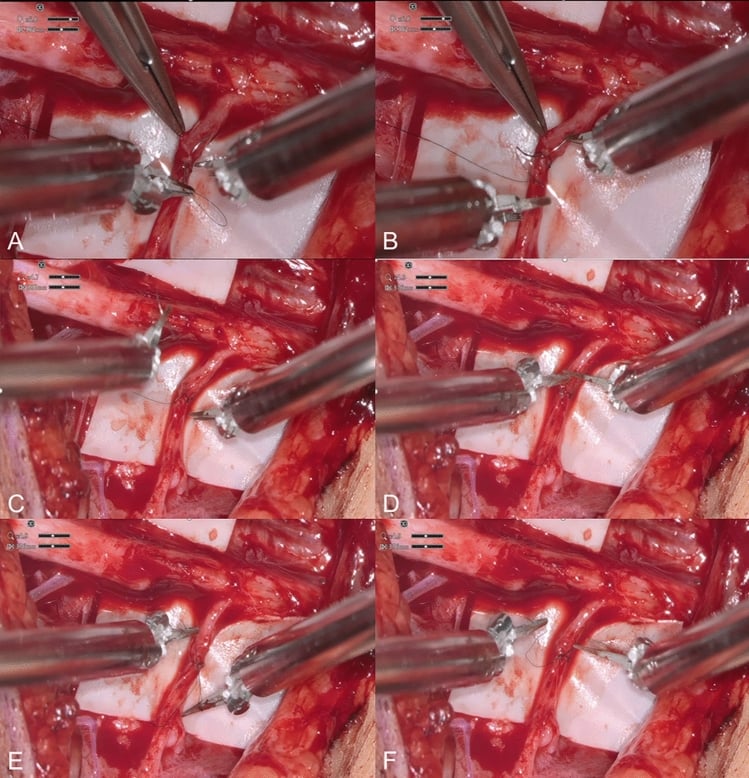 Microsurgical sequence of epineurial nerve coaptation with fine sutures