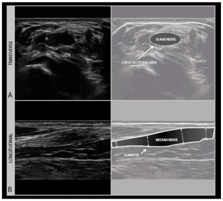 Transverse ulnar and longitudinal median nerve ultrasound showing neuroma cross-sectional area and diameter measurements