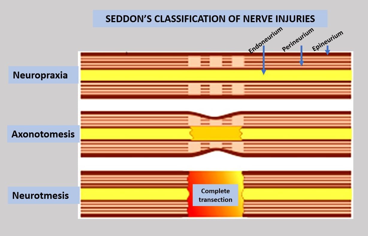 Diagram of Seddon's three grades of nerve injury (neurapraxia, axonotmesis, neurotmesis) with endoneurium, perineurium and epineurium labelled.