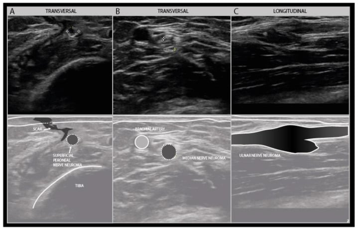 Transverse and longitudinal ultrasound examples of superficial peroneal, median and ulnar traumatic neuromas