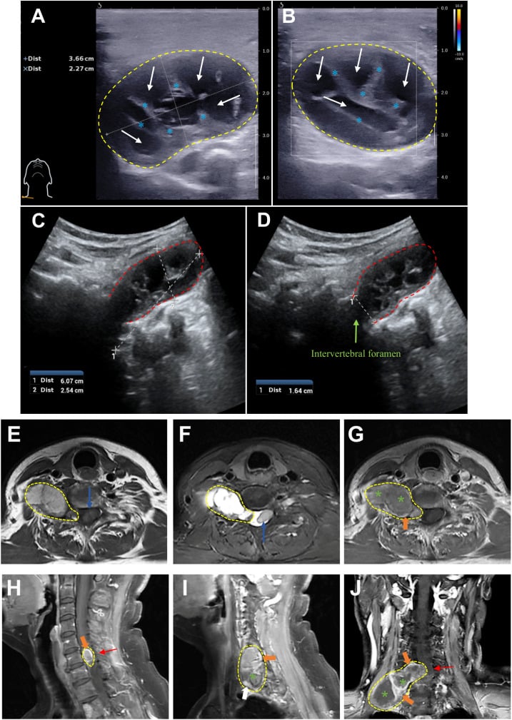 Ultrasound and multiplanar MRI of a giant dumbbell-shaped C5 cervical schwannoma