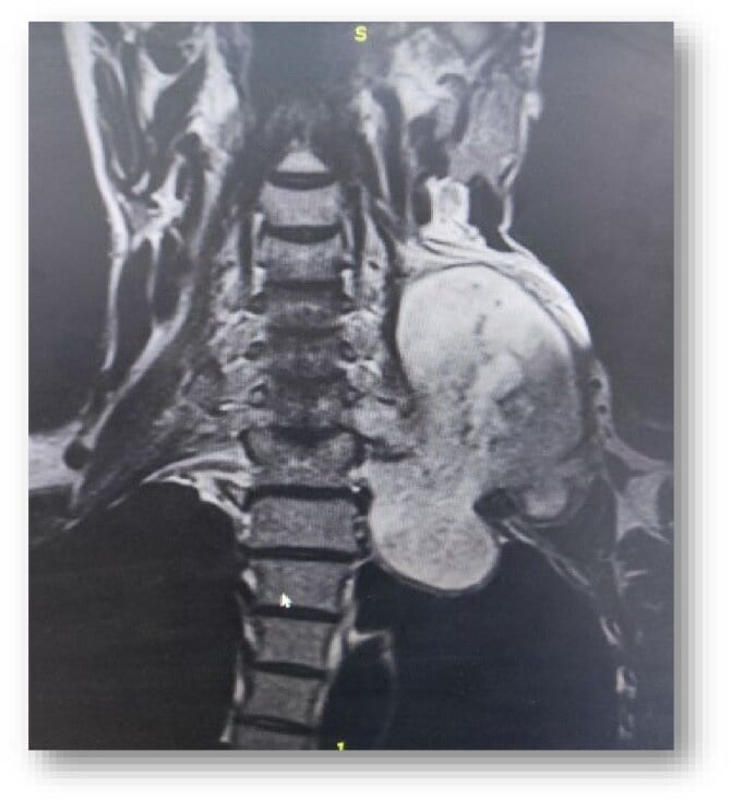 Coronal contrast-enhanced MRI showing a giant cervicothoracic dumbbell neurofibroma