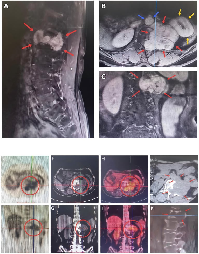 MRI PET and CT characterisation of a giant L1 dumbbell schwannoma with bone erosion