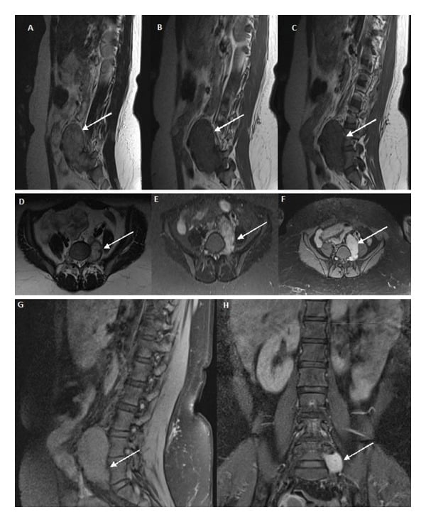 Multiplanar MRI of a giant L5-S1 foraminal and retroperitoneal schwannoma