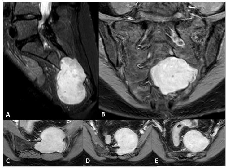 Multiplanar contrast-enhanced MRI of a giant sacral schwannoma with intraspinal and presacral components