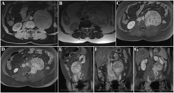 Multiplanar MRI showing a paravertebral schwannoma arising from the left L3-4 foramen