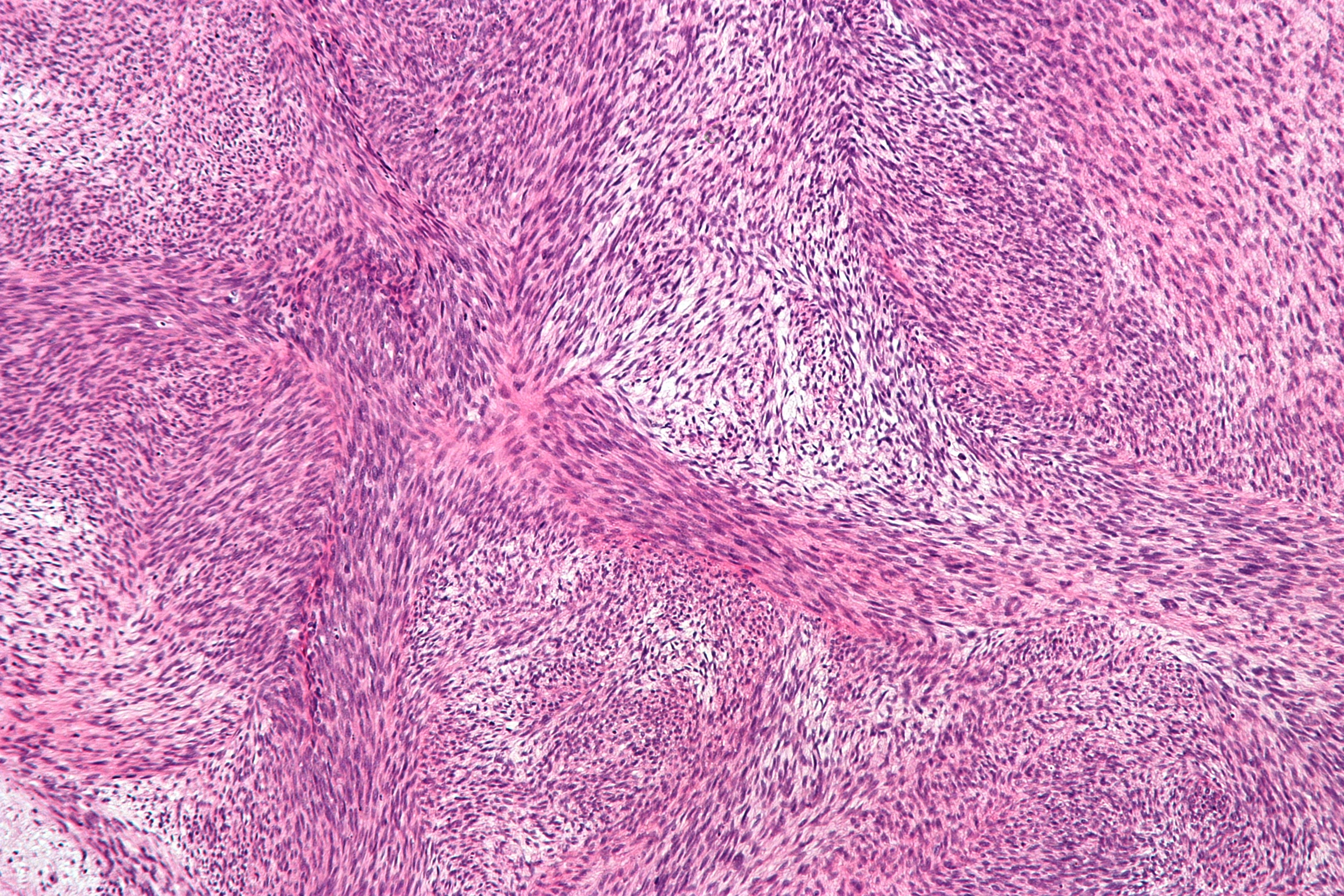 H&E histology of a malignant peripheral nerve sheath tumour showing hypercellular spindle-cell fascicles alternating with myxoid hypocellular zones.
