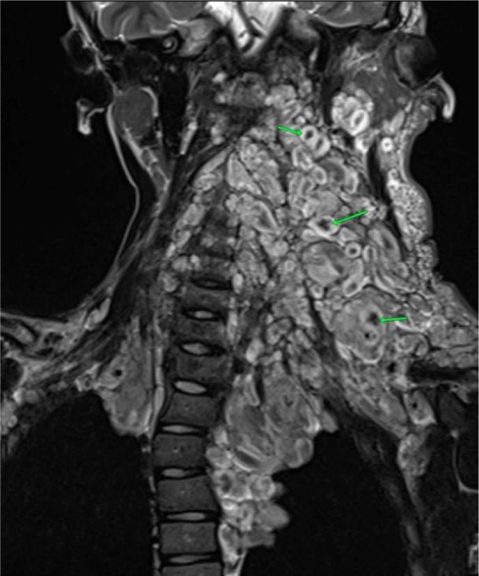 Coronal T2-weighted cervical MRI showing target-sign plexiform neurofibromas