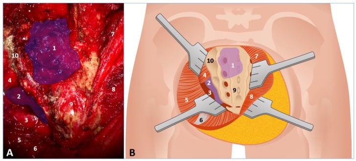 Operative and anatomical illustration of bone-preserving exposure for a giant sacral schwannoma